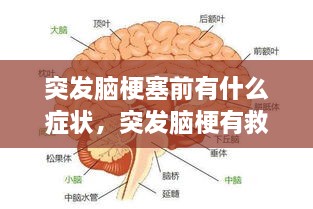 突发脑梗塞前有什么症状，突发脑梗有救吗 