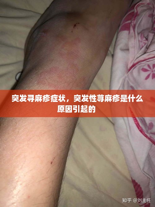 突发寻麻疹症状，突发性荨麻疹是什么原因引起的 