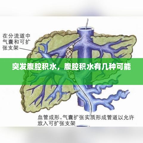 突发腹腔积水，腹腔积水有几种可能 