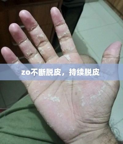 zo不断脱皮，持续脱皮 